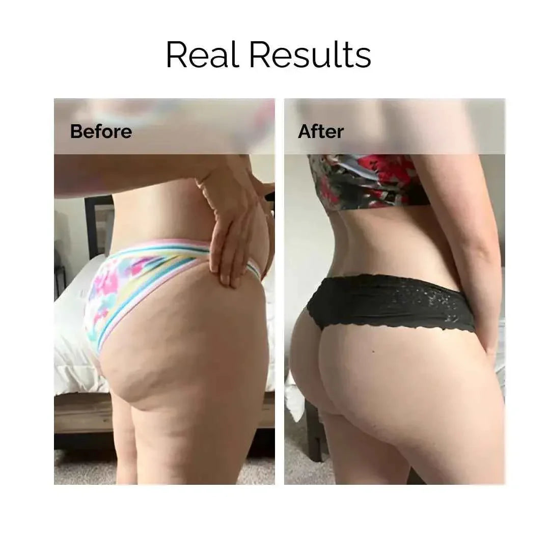 Before and after photo of woman's thighs and buttocks showing visible skin improvement results