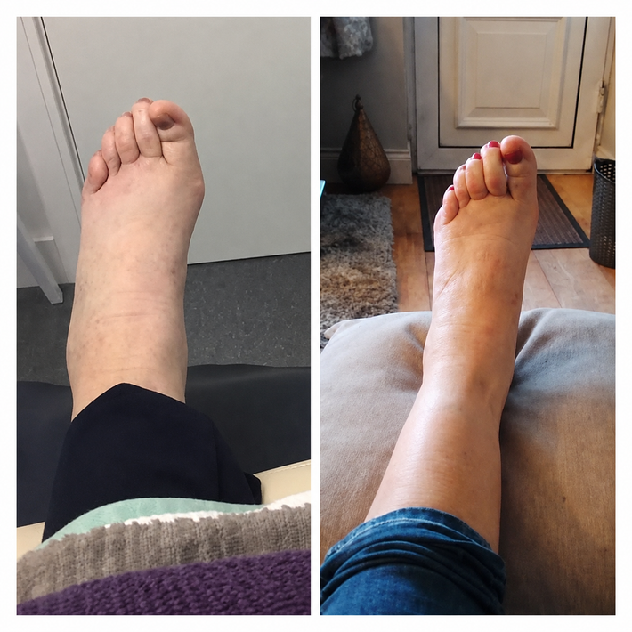 LumiSculpt LymphPro before and after result