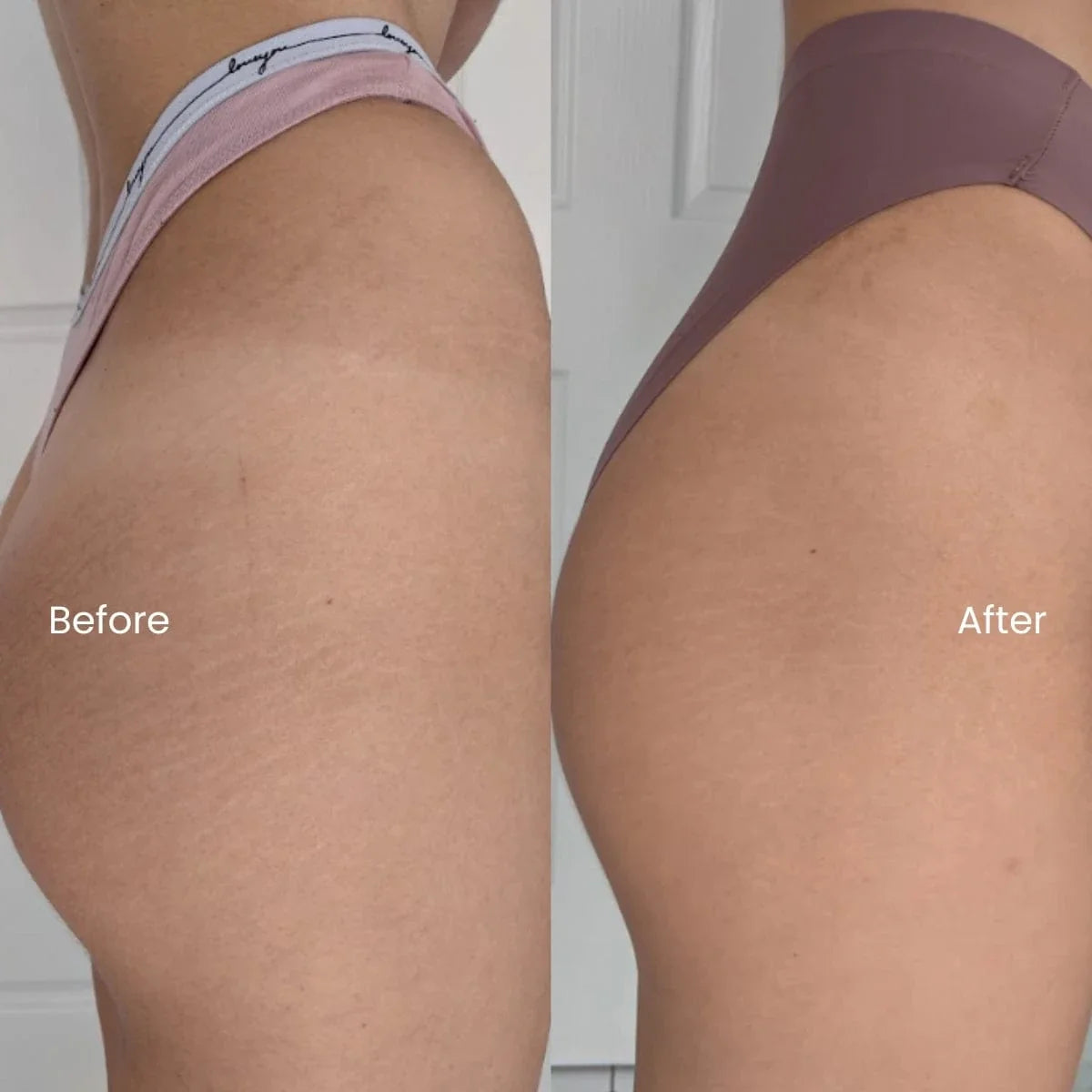 Customer before and after photo showing smoother thigh skin texture and less visible cellulite