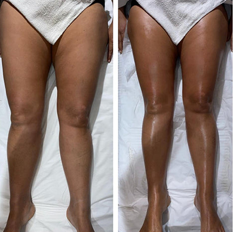 LumiSculpt LymphPro before and after appearance