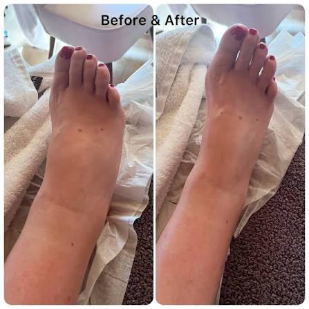 Customer before and after photo showing reduced ankle and foot swelling after lymphatic drainage massage