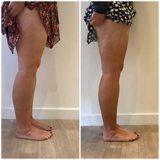 LumiSculpt LymphPro smoother looking skin result
