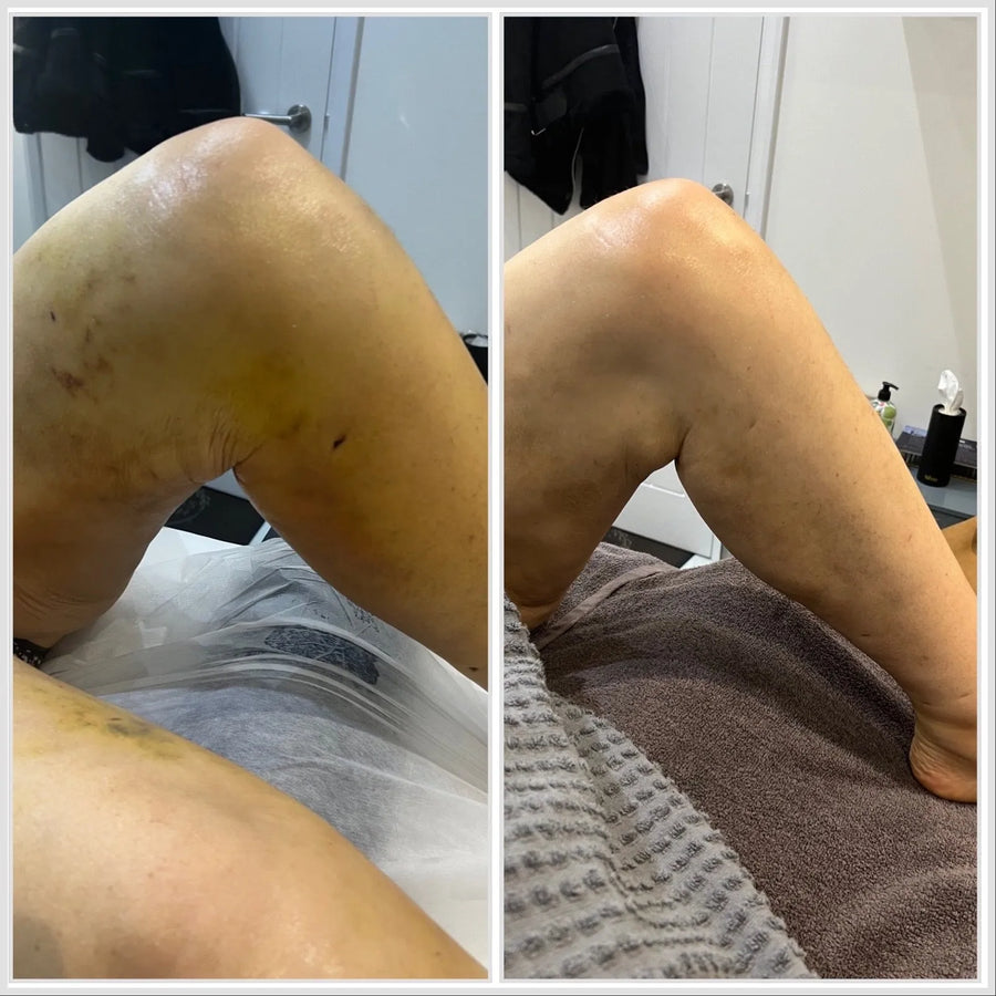 LumiSculpt LymphPro body massage before and after